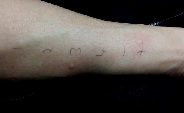 アレルギー検査